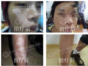 白癜风治疗方法 白癜风治疗方法