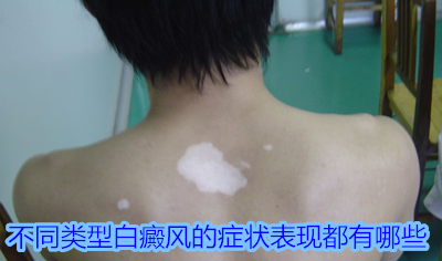 白癜风有哪些具体的症状表现
