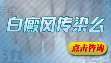 白癜风是否传染人