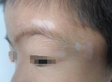 小孩得了白癜风还能好吗