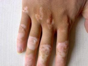 武汉手部白癜风有什么症状呢 武汉手部白癜风有什么症状呢