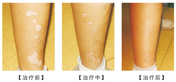 武汉中医治疗白癜风效果好吗 武汉早期白癜风治疗难度小