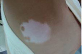 武汉白癜风病能够治好吗 武汉最新治疗白癜风的办法