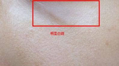 武汉最初白癜风什么症状