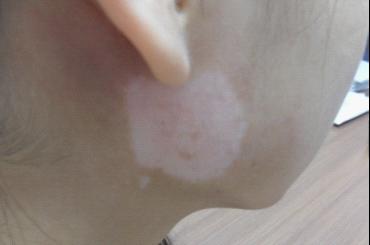 武汉白癜风症状会有什么变化 武汉白癜风症状会有什么变化