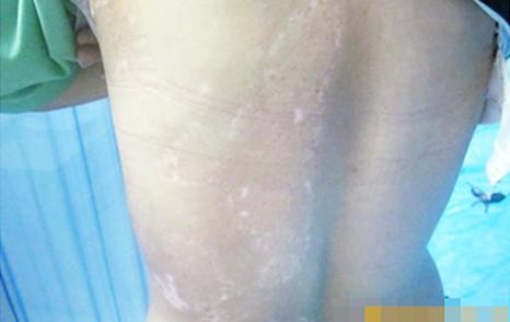 武汉长白癜风怎样治疗 武汉长白癜风怎样治疗