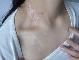 武汉治疗白癜风的常见方法有哪些 武汉治疗白癜风的常见方法有哪些