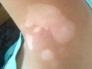 武汉常见的白癜风的治疗方法都有什么呢 武汉常见的白癜风的治疗方法都有什么呢