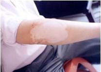 武汉身上长白斑怎么办 武汉什么样的方式才能准确治疗白癜风