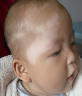 武汉治疗白癜风什么技术比较好 武汉白癜风什么手段能够治疗好