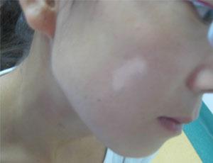 武汉白颠特临环亚 武汉治疗白环亚礼