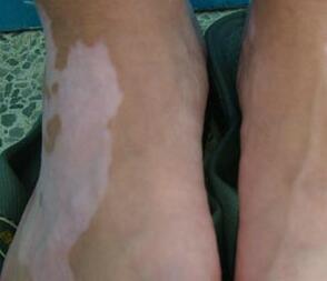 武汉白点须临环亚 武汉白斑须临环亚