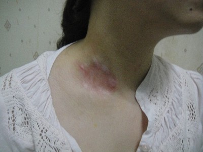 武汉治疗白殿环亚声名 武汉治疗白颠环亚特约