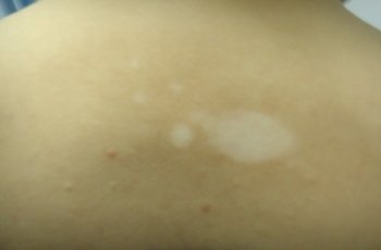 武汉治疗白巅环亚出彩 武汉治疗白殿环亚美赞