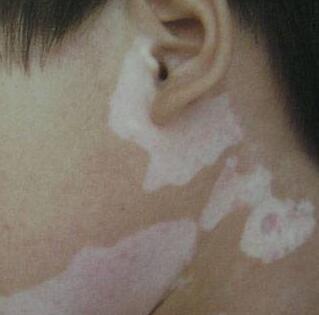 武汉医院治白环亚声名 武汉治疗白巅环亚声名