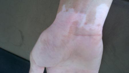 武汉医院治白环亚技术先进 武汉医院白环亚技术先进