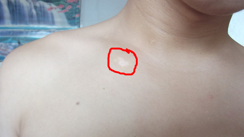 武汉治疗白颠环亚美赞 武汉白癫丰环亚