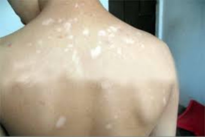 武汉白癫许环亚 武汉看白环亚出