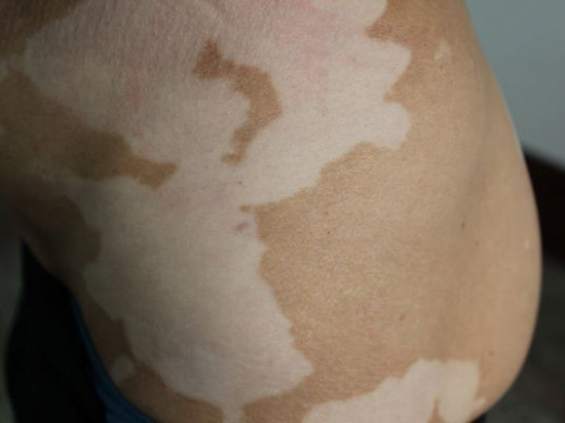 武汉医院看白环亚夸 武汉看白殿丰环亚