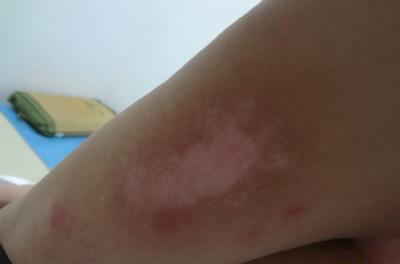 武汉白殿众询环亚 武汉医院治白环亚声名