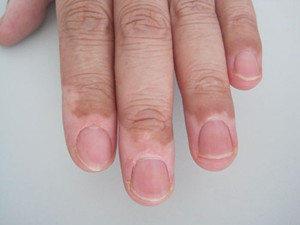 武汉看白颠疯认准环亚电话 武汉治白殿环亚出彩