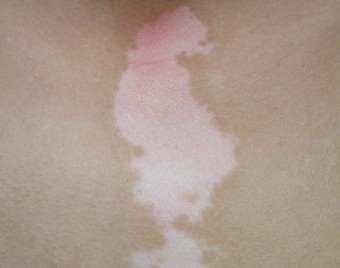 武汉白斑环亚特约 武汉治疗白巅环亚声名