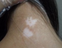 武汉治疗白巅环亚美赞 武汉治白颠环亚出彩