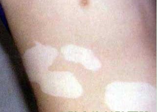 武汉治白颠环亚特约 武汉看白开环亚