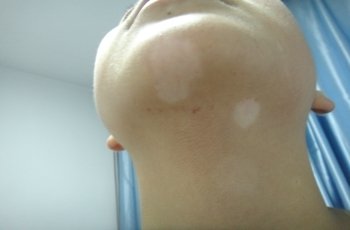 武汉看白斑医院