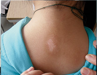 武汉治疗白斑效果好吗