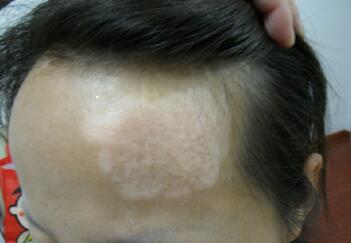 武汉专业看白癜风医院 武汉专业看白癜风的医院