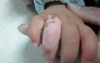 武汉哪家医院治疗白癜风最好 武汉哪家医院治疗白癜风好