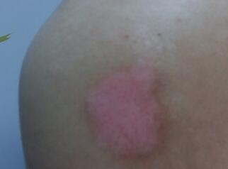 武汉治白癜风最好医院排名 武汉治白癜风最好的医院是哪家