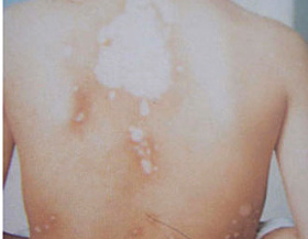 武汉哪家医院治白癜风比较好 武汉哪家医院治白癜风