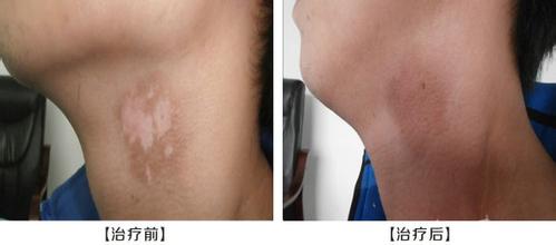 武汉治疗白癜风三甲医院 武汉治疗白癜风的医院在哪里