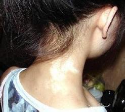 武汉治疗白癜风的正规医院 武汉治疗白癜风正规医院