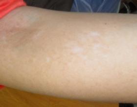 武汉哪个医院治白斑比较好 武汉哪家医院可以治白斑