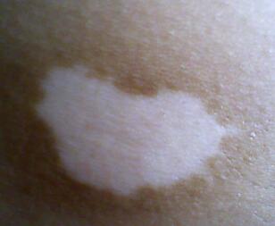 武汉308激光治白癜风价格是多少 武汉308激光治白癜风