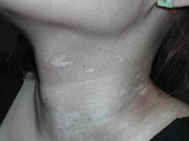 武汉治白癜风哪家好 武汉308激光治白癜风费用多少钱