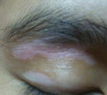 武汉308激光治白癜风哪家医院最好 武汉308激光治白癜风哪家好