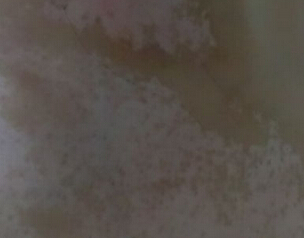 武汉308激光治白癜风哪里好 武汉治白癜风哪家医院好