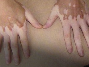 武汉治疗白癜风的医院哪家最好 武汉治疗白癜风的医院