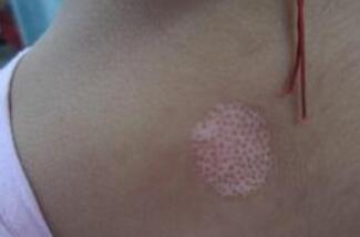 武汉看白癜风的医院哪家最好 武汉看白癜风的医院