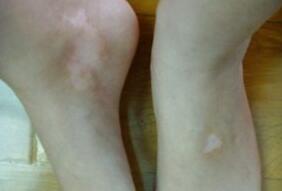 武汉看白癜风正规医院 武汉看白癜风三甲医院