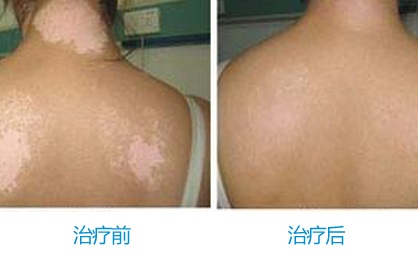 武汉治疗白斑最好的医院 武汉治疗白斑的医院排名