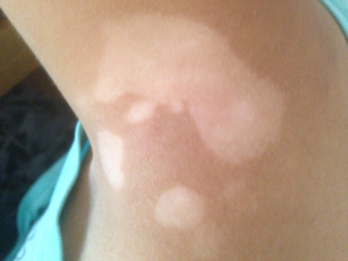 武汉有专门看白癜风的医院吗 武汉哪家医院看白癜风比较好