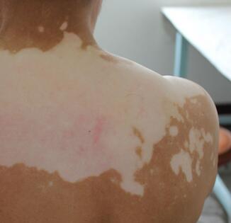 儿童得了白癜风该怎么办 颈部出现白斑怎么治