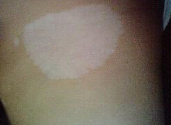 白癜风扩散的原因是什么 青少年白癜风是如何引起的