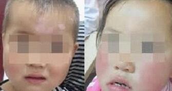 白癜风的确切诊断方法 得了白癜风能不能治好