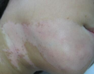 白癜风预防小知识 白癜风预防和治疗